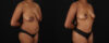 Mommy Makeover case #6689 slider thumbnail