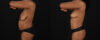 Mommy Makeover case #6689 slider thumbnail