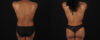 Mommy Makeover case #6689 slider thumbnail