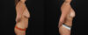 Mommy Makeover case #6690 slider thumbnail