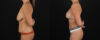 Mommy Makeover case #6690 slider thumbnail
