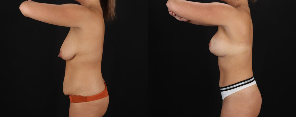 Mommy Makeover case #6690