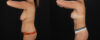 Mommy Makeover case #6690 slider thumbnail