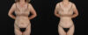 Mommy Makeover case #6767 slider thumbnail