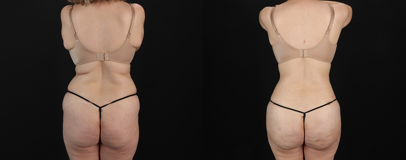 Mommy-Makeover-Before-and-After-Photo-by-Dr.-Erika-A.-Sato-in-Houston-TX-258498-10