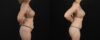 Mommy Makeover case #6767 slider thumbnail