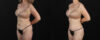 Mommy Makeover case #6767 slider thumbnail