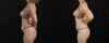 Mommy Makeover case #6767 slider thumbnail