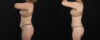 Mommy Makeover case #6767 slider thumbnail