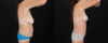 Mommy Makeover case #6691 slider thumbnail