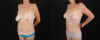 Mommy Makeover case #6691 slider thumbnail