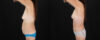 Mommy Makeover case #6691 slider thumbnail