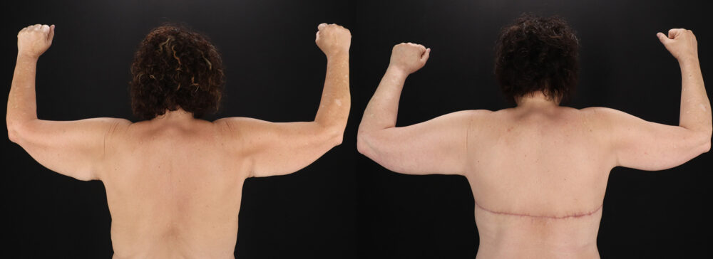 Post Bariatric Surgery (Massive Weight Loss) case #6785