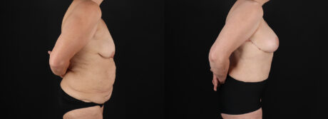Post Bariatric Surgery (Massive Weight Loss) case #6785