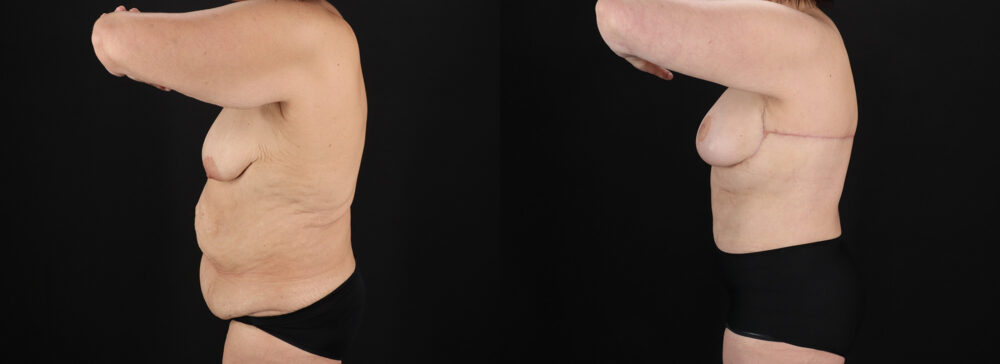 Post Bariatric Surgery (Massive Weight Loss) case #6785