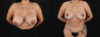 Revision Breast Surgery case #256274 slider thumbnail
