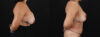 Revision Breast Surgery case #256274 slider thumbnail