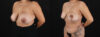 Revision Breast Surgery case #256274 slider thumbnail