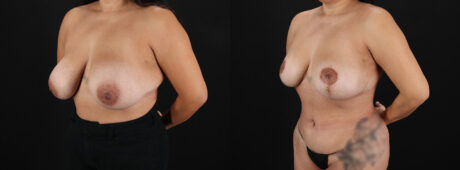 Revision Breast Surgery case #256274