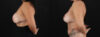 Revision Breast Surgery case #256274 slider thumbnail