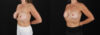 Revision Breast Surgery case #256282 slider thumbnail