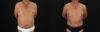 Tummy Tuck case #7623 slider thumbnail