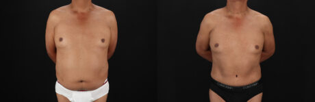 Tummy Tuck case #7623