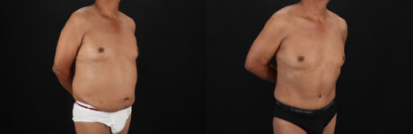 Tummy Tuck case #7623