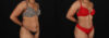 Tummy Tuck case #7777 slider thumbnail