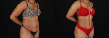 Tummy Tuck case #7777