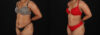 Tummy Tuck case #7777 slider thumbnail