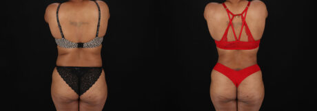 Tummy Tuck case #7777