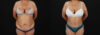 Tummy Tuck case #7778 slider thumbnail