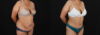 Tummy Tuck case #7778 slider thumbnail