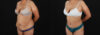 Tummy Tuck case #7778 slider thumbnail