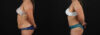 Tummy Tuck case #7778 slider thumbnail