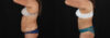 Tummy Tuck case #7778 slider thumbnail
