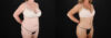 Tummy Tuck case #7779 slider thumbnail