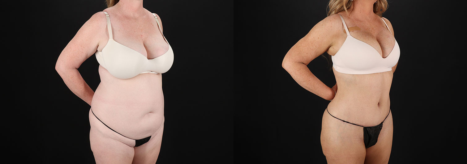 Tummy-Tuck-Before-and-After-Photo-by-Dr.-Erika-A.-Sato-in-Houston-TX-258216-2