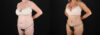 Tummy Tuck case #7779 slider thumbnail