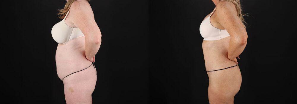 Tummy Tuck case #7779