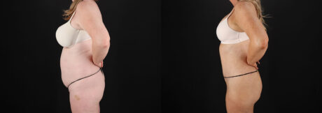 Tummy Tuck case #7779