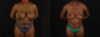 Tummy Tuck case #7780 slider thumbnail