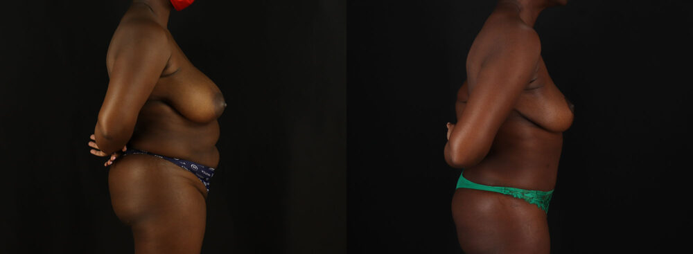 Tummy Tuck case #7780
