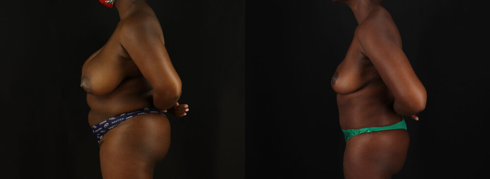 Tummy Tuck case #7780