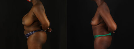 Tummy Tuck case #7780