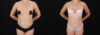 Tummy Tuck case #7776 slider thumbnail