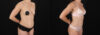 Tummy Tuck case #7776 slider thumbnail
