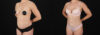 Tummy Tuck case #7776 slider thumbnail