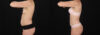 Tummy Tuck case #7776 slider thumbnail